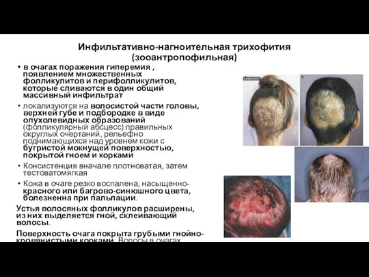 Инфильтативно-нагноительная трихофития (зооантропофильная) в очагах поражения гиперемия , появлением множественных фолликулитов и