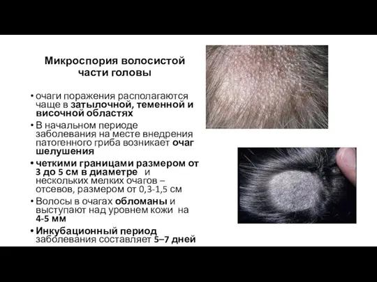 Микроспория волосистой части головы очаги поражения располагаются чаще в затылочной, теменной и