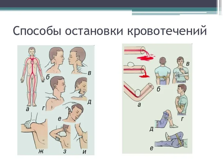 Способы остановки кровотечений