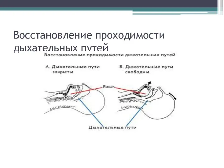 Восстановление проходимости дыхательных путей