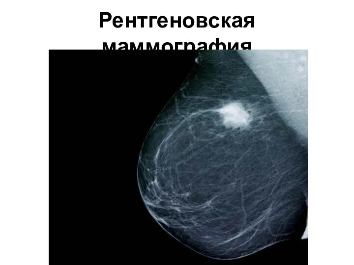 Рентгеновская маммография