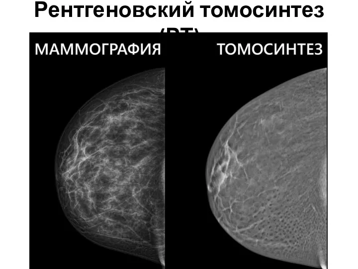 Рентгеновский томосинтез (РТ)