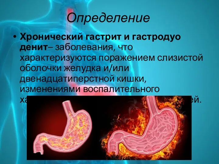 Определение Хронический гастрит и гастродуо­денит– заболевания, что характеризуются поражением слизистой оболочки желудка
