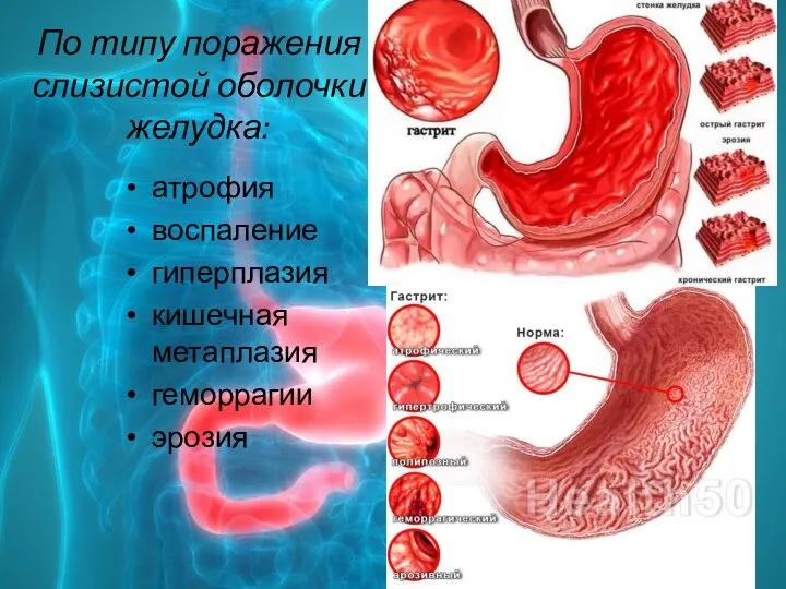 По типу поражения слизистой оболочки желудка: атрофия воспаление гиперплазия кишечная метаплазия геморрагии эрозия