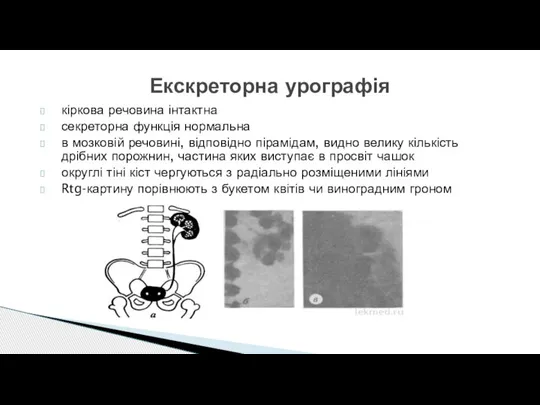 кіркова речовина інтактна секреторна функція нормальна в мозковій речовині, відповідно пірамідам, видно