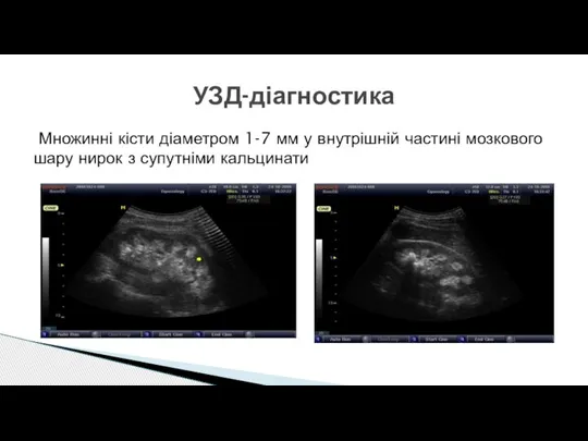 Множинні кісти діаметром 1-7 мм у внутрішній частині мозкового шару нирок з супутніми кальцинати УЗД-діагностика