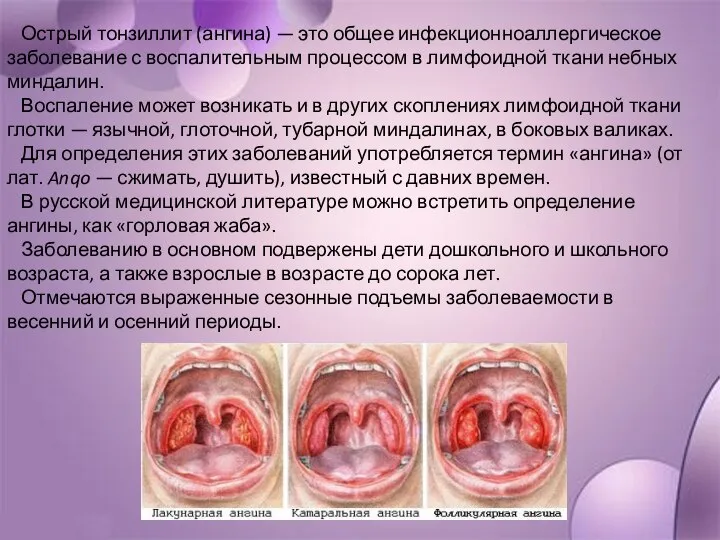Острый тонзиллит (ангина) — это общее инфекционноаллергическое заболевание с воспалительным процессом в