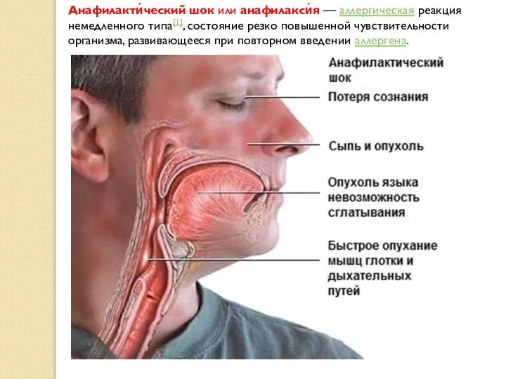 Анафилакти́ческий шок или анафилакси́я — аллергическая реакция немедленного типа[1], состояние резко повышенной