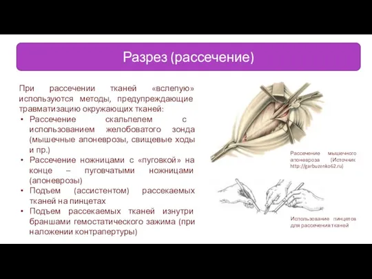 Разрез (рассечение) Рассечение мышечного апоневроза (Источник http://garbuzenko62.ru) При рассечении тканей «вслепую» используются