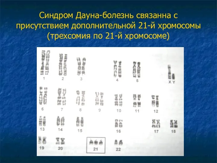 Синдром Дауна-болезнь связанна с присутствием дополнительной 21-й хромосомы(трехсомия по 21-й хромосоме)