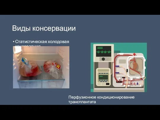 Виды консервации Статистическая холодовая консервация Перфузионное кондиционирование трансплантата