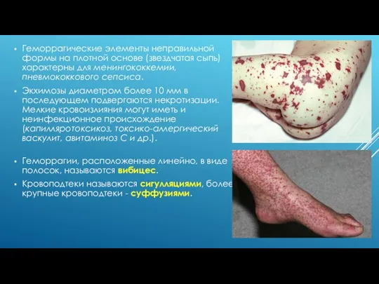 Геморрагические элементы неправильной формы на плотной основе (звездчатая сыпь) характерны для менингококкемии,