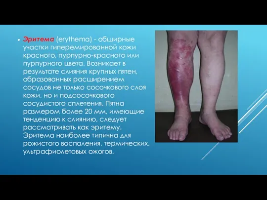 Эритема (erythema) - обширные участки гиперемированной кожи красного, пурпурно-красного или пурпурного цвета.