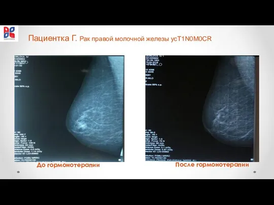 Пациентка Г. Рак правой молочной железы yсТ1N0M0CR До гормонотерапии После гормонотерапии