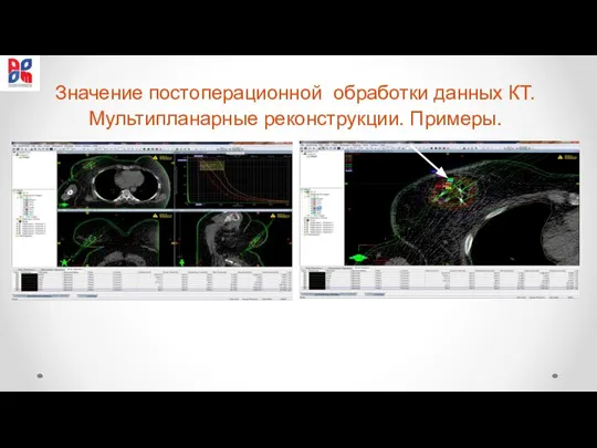 Значение постоперационной обработки данных КТ. Мультипланарные реконструкции. Примеры.