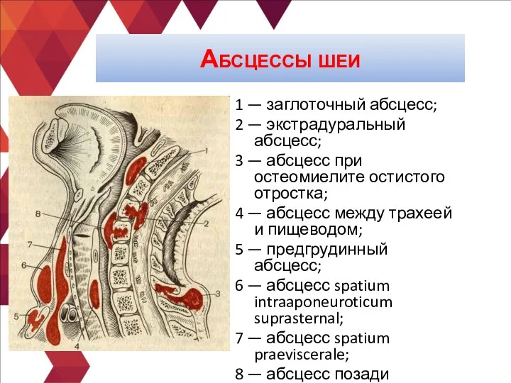 1 — заглоточный абсцесс; 2 — экстрадуральный абсцесс; 3 — абсцесс при