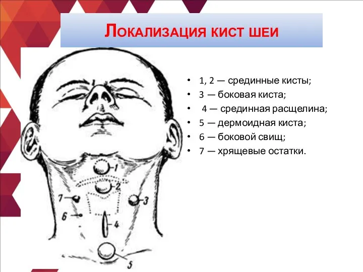 Локализация кист шеи 1, 2 — срединные кисты; 3 — боковая киста;