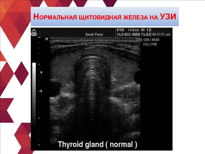 Нормальная щитовидная железа на УЗИ