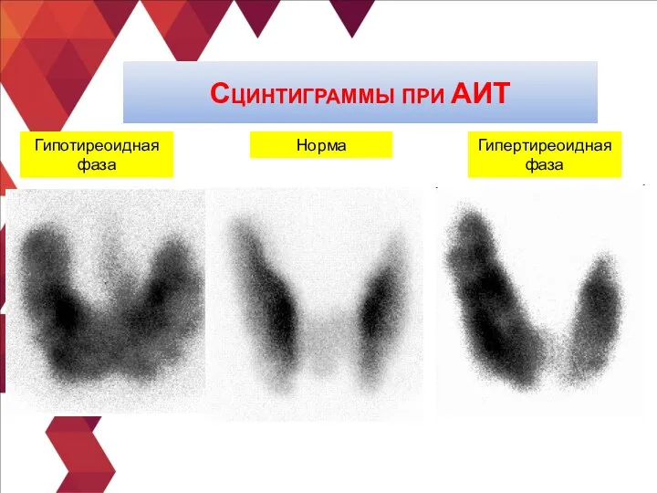 Сцинтиграммы при АИТ Норма Гипотиреоидная фаза Гипертиреоидная фаза