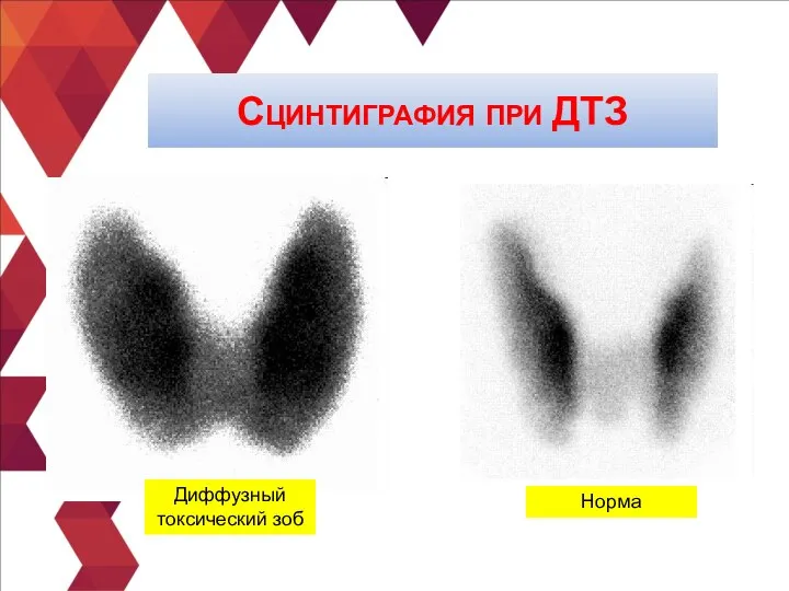 Сцинтиграфия при ДТЗ Норма Диффузный токсический зоб