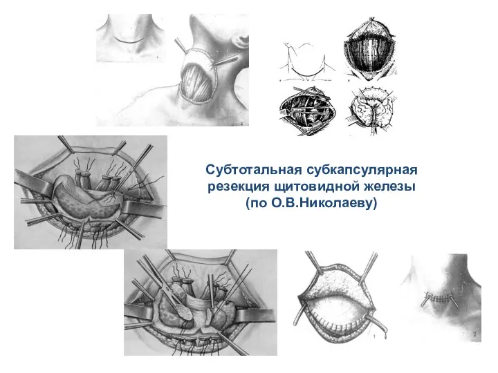 Субтотальная субкапсулярная резекция щитовидной железы (по О.В.Николаеву)