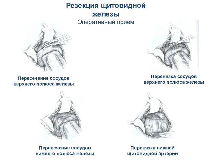 Резекция щитовидной железы Оперативный прием Пересечение сосудов верхнего полюса железы Перевязка сосудов