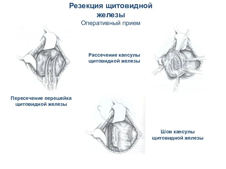Резекция щитовидной железы Оперативный прием Пересечение перешейка щитовидной железы Рассечение капсулы щитовидной