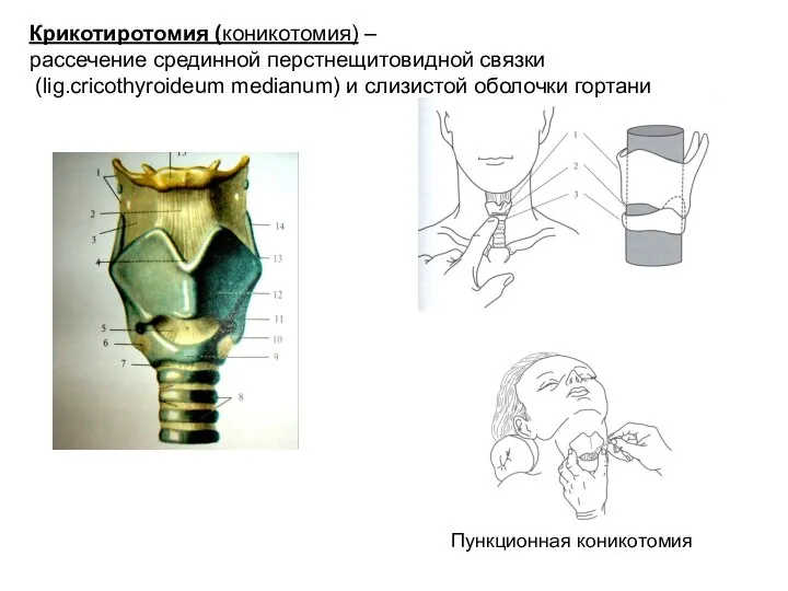 Крикотиротомия (коникотомия) – рассечение срединной перстнещитовидной связки (lig.cricothyroideum medianum) и слизистой оболочки гортани Пункционная коникотомия