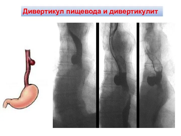 Дивертикул пищевода и дивертикулит