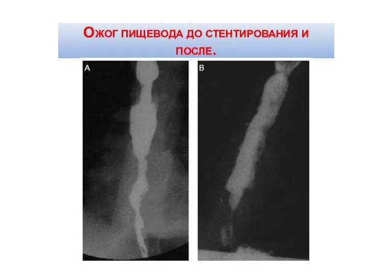 Ожог пищевода до стентирования и после.