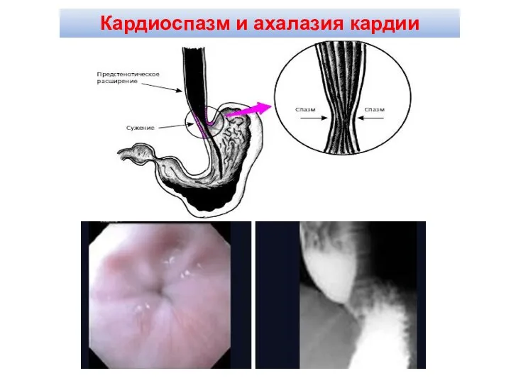 Кардиоспазм и ахалазия кардии