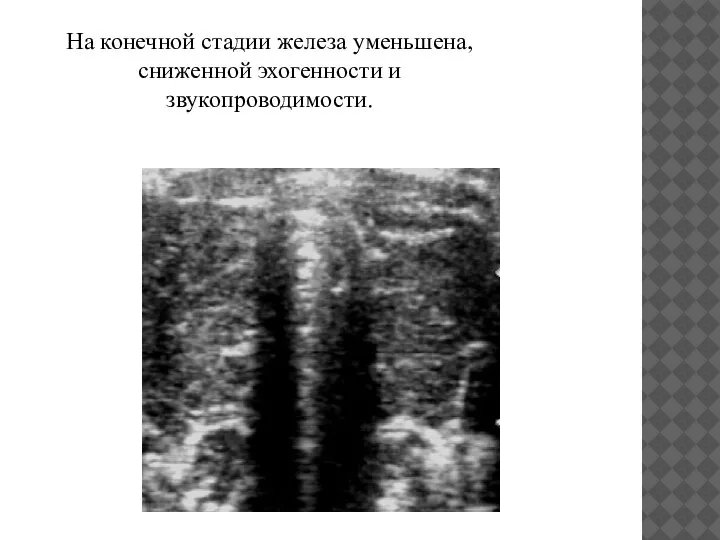 На конечной стадии железа уменьшена, сниженной эхогенности и звукопроводимости.