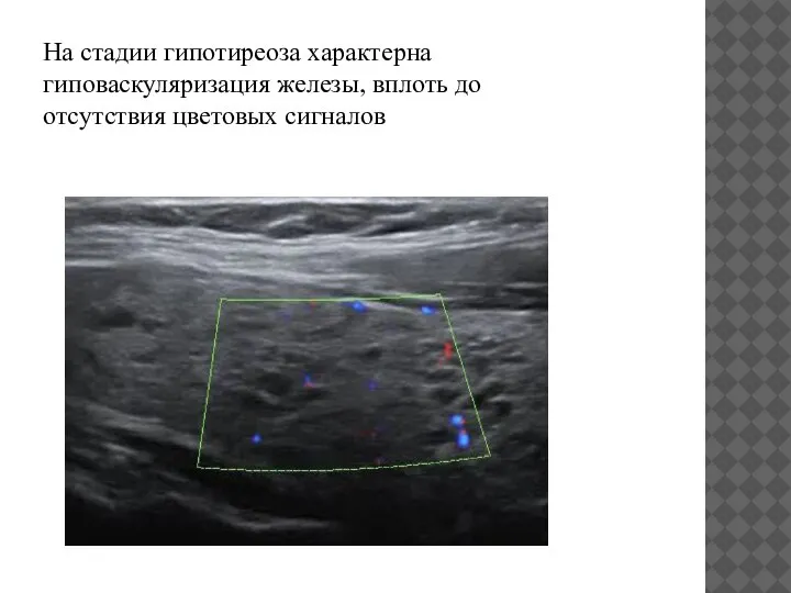 На стадии гипотиреоза характерна гиповаскуляризация железы, вплоть до отсутствия цветовых сигналов