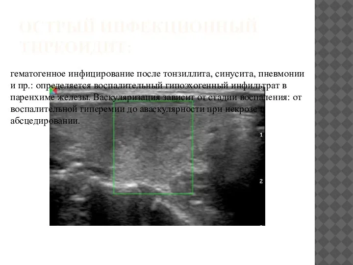 ОСТРЫЙ ИНФЕКЦИОННЫЙ ТИРЕОИДИТ: гематогенное инфицирование после тонзиллита, синусита, пневмонии и пр.: определяется