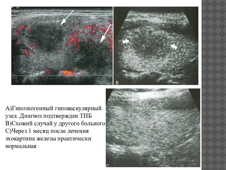 . A)Гипоэхогенный гиповаскулярный узел. Диагноз подтвержден ТИБ B)Схожий случай у другого больного