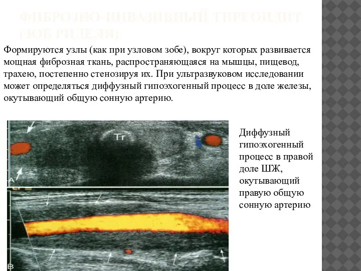 ФИБРОЗНО-ИНВАЗИВНЫЙ ТИРЕОИДИТ (ЗОБ РИДЕЛЯ) Формируются узлы (как при узловом зобе), вокруг которых