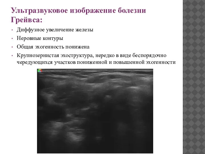 Ультразвуковое изображение болезни Грейвса: Диффузное увеличение железы Неровные контуры Общая эхогенность понижена
