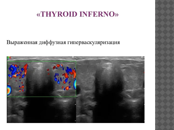 «THYROID INFERNO» Выраженная диффузная гиперваскуляризация