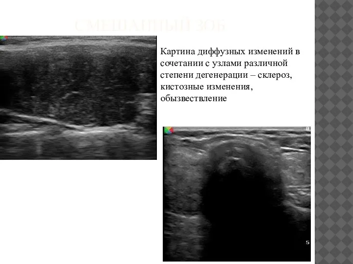 СМЕШАННЫЙ ЗОБ Картина диффузных изменений в сочетании с узлами различной степени дегенерации