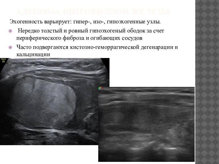 АДЕНОМА ЩИТОВИДНОЙ ЖЕЛЕЗЫ Эхогенность варьирует: гипер-, изо-, гипоэхогенные узлы. Нередко толстый и