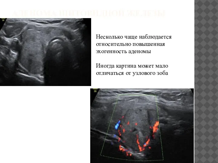 АДЕНОМА ЩИТОВИДНОЙ ЖЕЛЕЗЫ Несколько чаще наблюдается относительно повышенная эхогенность аденомы Иногда картина