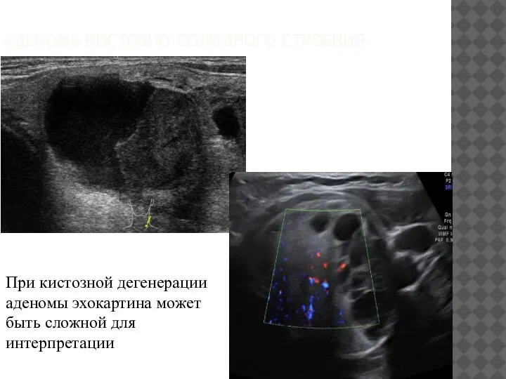 АДЕНОМА КИСТОЗНО-СОЛИДНОГО СТРОЕНИЯ При кистозной дегенерации аденомы эхокартина может быть сложной для интерпретации