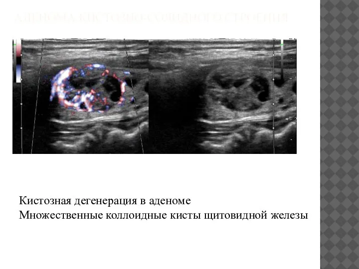АДЕНОМА КИСТОЗНО-СОЛИДНОГО СТРОЕНИЯ Кистозная дегенерация в аденоме Множественные коллоидные кисты щитовидной железы
