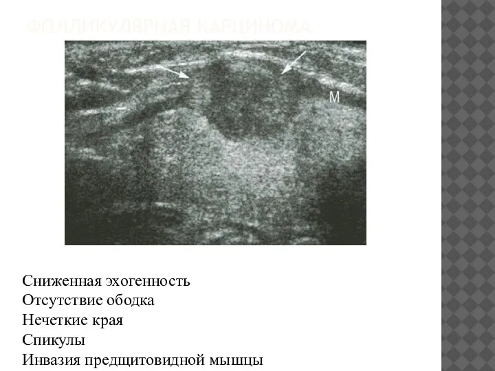 ФОЛЛИКУЛЯРНАЯ КАРЦИНОМА Сниженная эхогенность Отсутствие ободка Нечеткие края Спикулы Инвазия предщитовидной мышцы