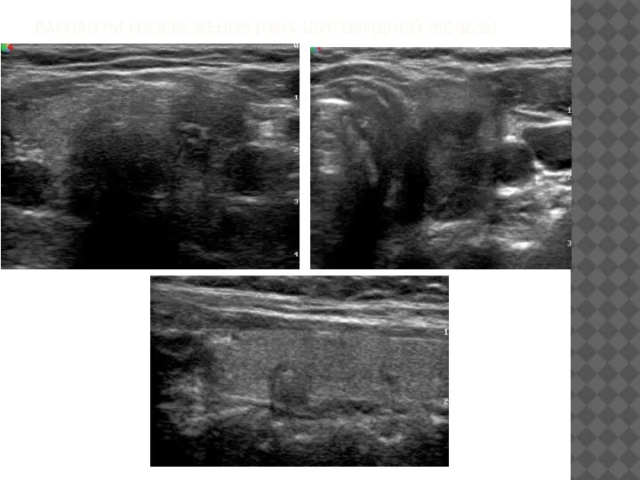 ВАРИАНТЫ ИЗОБРАЖЕНИЯ РАКА ЩИТОВИДНОЙ ЖЕЛЕЗЫ