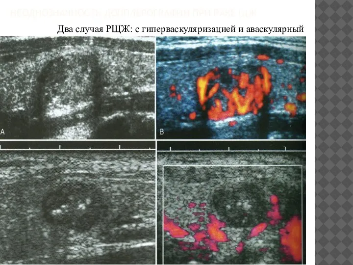 НЕОДНОЗНАЧНОСТЬ ДОППЛЕРОГРАФИИ ПРИ РАКЕ ЩЖ Два случая РЩЖ: с гиперваскуляризацией и аваскулярный