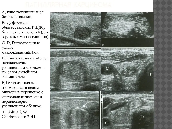 ПАПИЛЛЯРНАЯ КАРЦИНОМА A, гипоэхогенный узел без кальцинатов B, Диффузное обызвествление РЩЖ у
