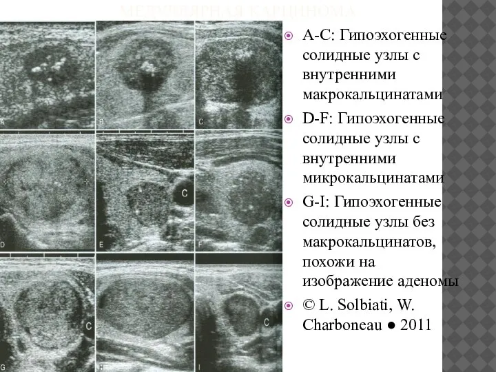 МЕДУЛЛЯРНАЯ КАРЦИНОМА A-C: Гипоэхогенные солидные узлы с внутренними макрокальцинатами D-F: Гипоэхогенные солидные