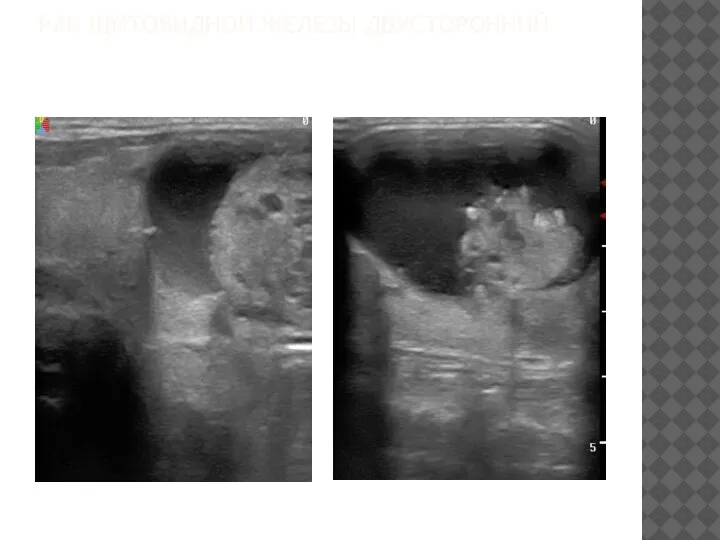 РАК ЩИТОВИДНОЙ ЖЕЛЕЗЫ ДВУСТОРОННИЙ