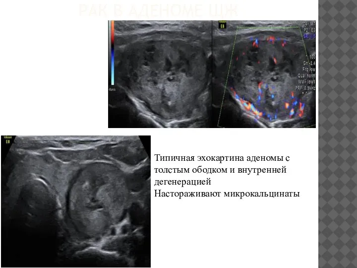 РАК В АДЕНОМЕ ЩЖ Типичная эхокартина аденомы с толстым ободком и внутренней дегенерацией Настораживают микрокальцинаты